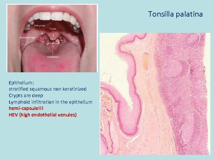 Tonsilla palatina Epithelium: stratified squamous non keratinized Crypts are deep Lymphoid infiltration in the