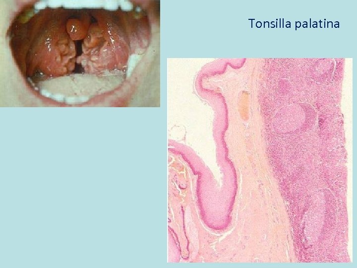Tonsilla palatina 