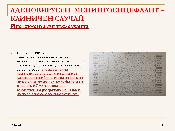AДЕНОВИРУСЕН МЕНИНГОЕНЦЕФАЛИТ – КЛИНИЧЕН СЛУЧАЙ Инструментални изследвания n ЕЕГ (23. 06. 2017): Генерализирана пароксизмална