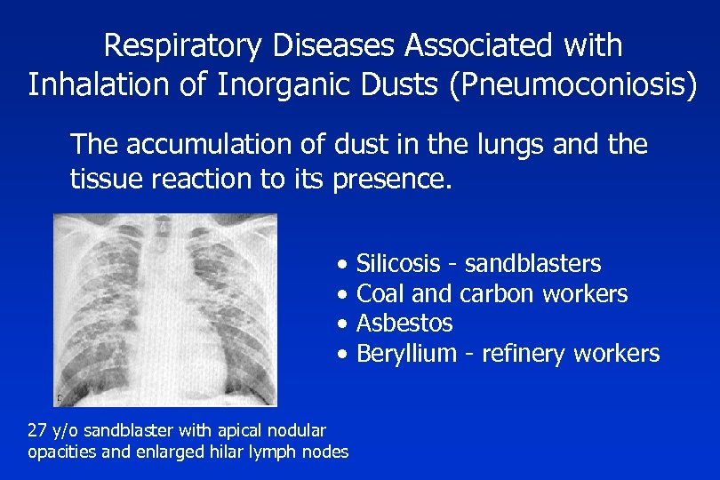 Respiratory Diseases Associated with Inhalation of Inorganic Dusts (Pneumoconiosis) The accumulation of dust in
