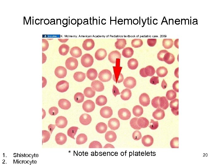 Microangiopathic Hemolytic Anemia K. Mc. Inerny. American Academy of Pediatrics textbook of pediatric care.