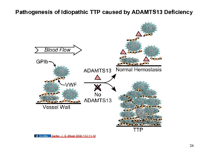 Pathogenesis of Idiopathic TTP caused by ADAMTS 13 Deficiency Sadler, J. E. Blood 2008;
