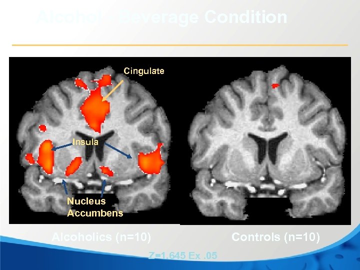 Alcohol - Beverage Condition Cingulate Insula Nucleus Accumbens Alcoholics (n=10) Z=1. 645 Ex. 05