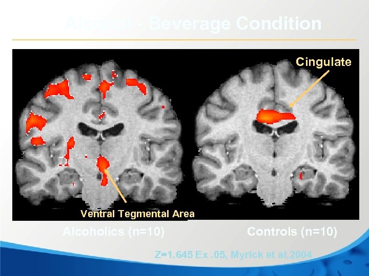 Alcohol - Beverage Condition Cingulate Ventral Tegmental Area Alcoholics (n=10) Controls (n=10) Z=1. 645