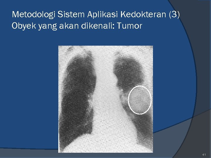 Metodologi Sistem Aplikasi Kedokteran (3) Obyek yang akan dikenali: Tumor 41 