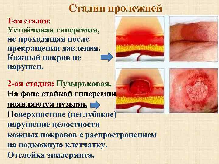     Стадии пролежней 1 -ая стадия:  Устойчивая гиперемия,  не