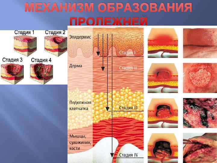 Места образования пролежней у пациента длительной сидящего на кресле тест