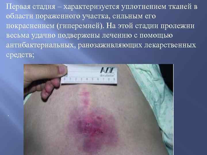 Первая стадия – характеризуется уплотнением тканей в области пораженного участка, сильным его покраснением (гиперемией).