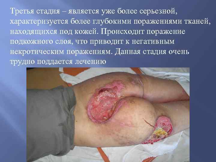 Третья стадия – является уже более серьезной, характеризуется более глубокими поражениями тканей, находящихся под