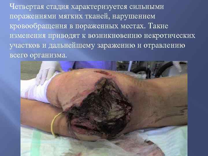 Четвертая стадия характеризуется сильными поражениями мягких тканей, нарушением кровообращения в пораженных местах. Такие изменения