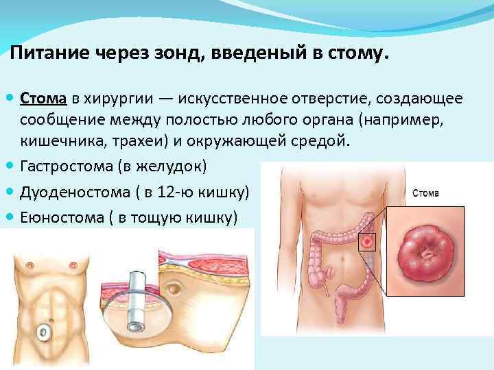 Питание через зонд, введеный в стому. Стома в хирургии — искусственное отверстие, создающее 