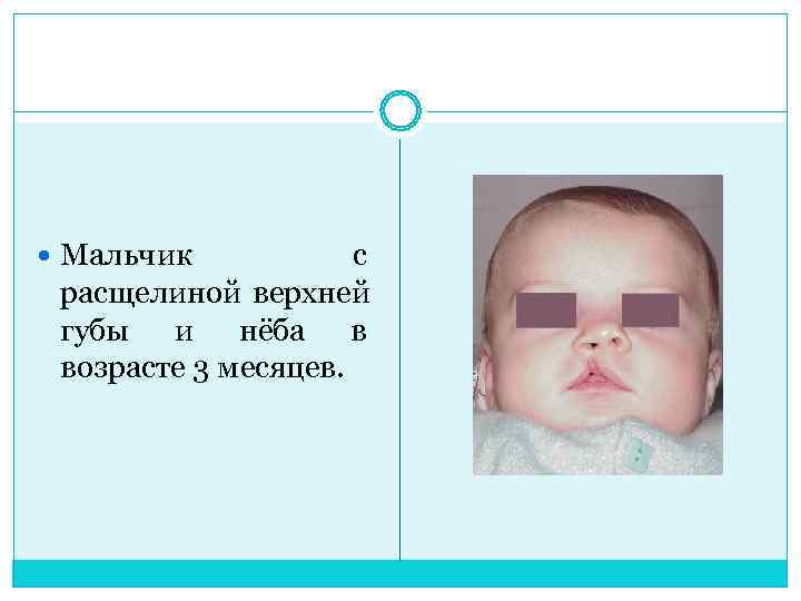  Мальчик  с  расщелиной верхней  губы и нёба в  возрасте