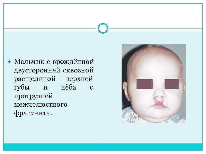  Мальчик с врождённой  двусторонней сквозной  расщелиной верхней  губы  и