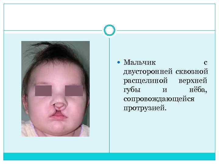  Мальчик   с  двусторонней сквозной  расщелиной верхней  губы и