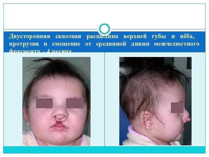 Двусторонняя сквозная расщелина верхней губы и нёба, протрузия и смещение от срединной линии межчелюстного