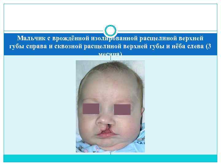  Мальчик с врождённой изолированной расщелиной верхней губы справа и сквозной расщелиной верхней губы