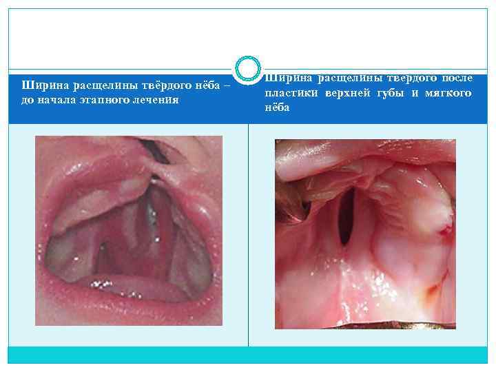       Ширина расщелины твёрдого после Ширина расщелины твёрдого нёба