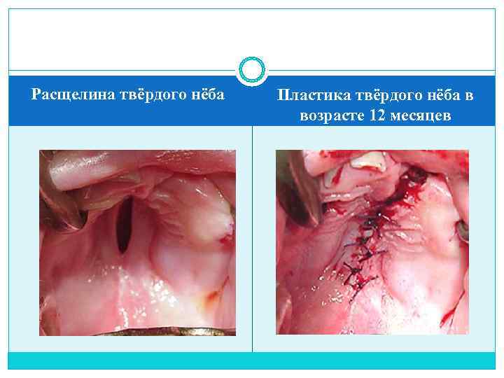 Расщелина твёрдого нёба  Пластика твёрдого нёба в     возрасте 12