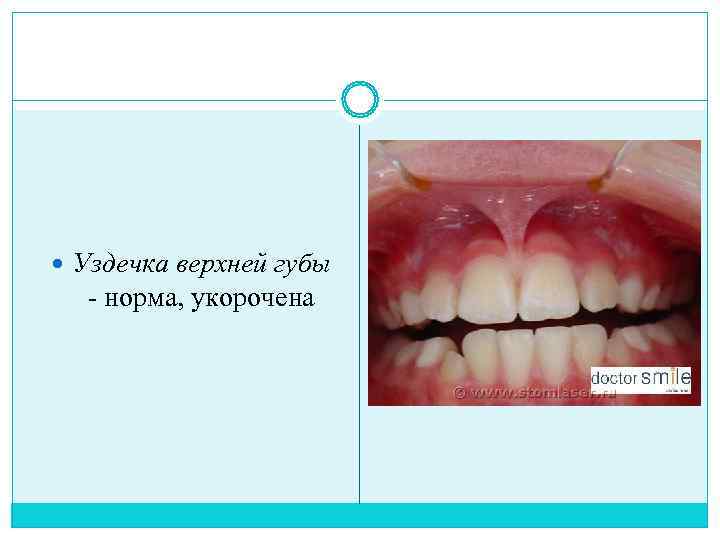  Уздечка верхней губы норма, укорочена 