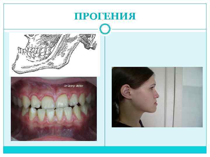 Прогения и прогнатия картинки