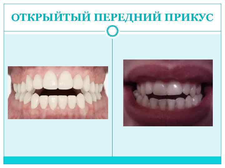 ОТКРЫЙТЫЙ ПЕРЕДНИЙ ПРИКУС 