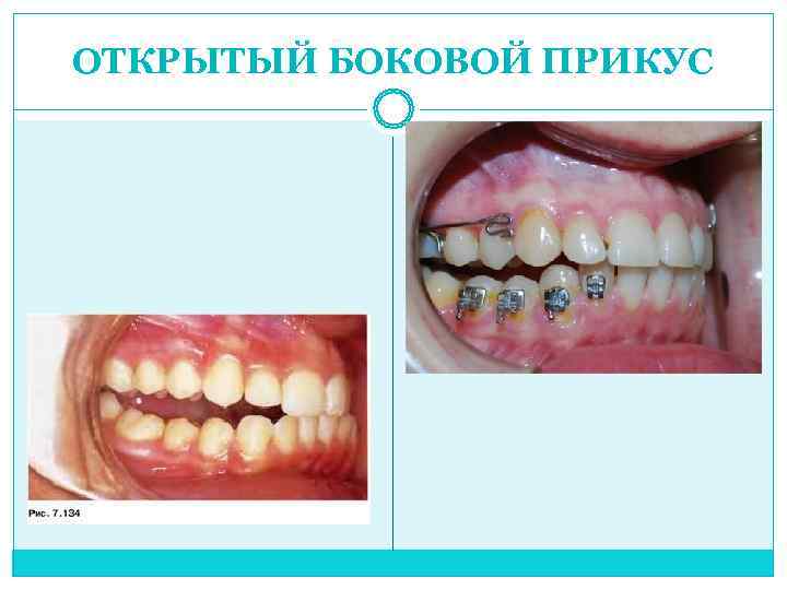 ОТКРЫТЫЙ БОКОВОЙ ПРИКУС 