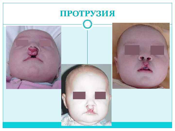 ПРОТРУЗИЯ 