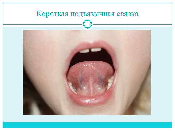 Короткая подъязычная связка 