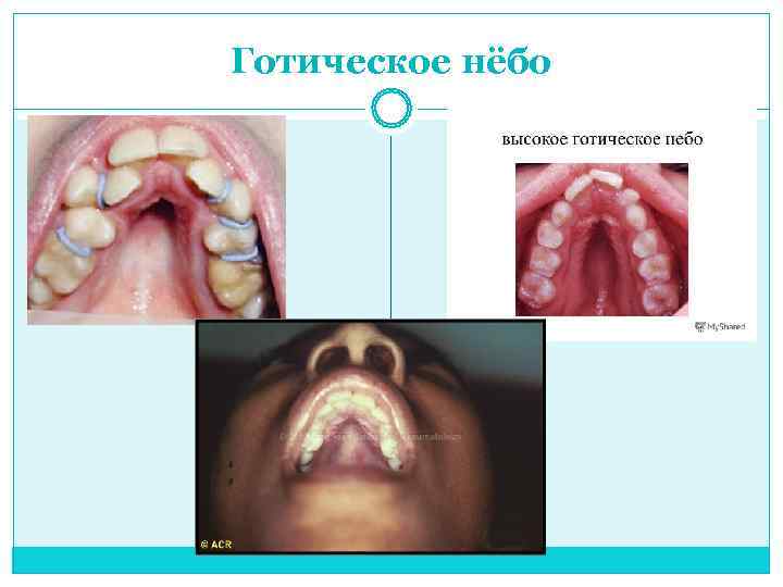 Готическое нёбо 