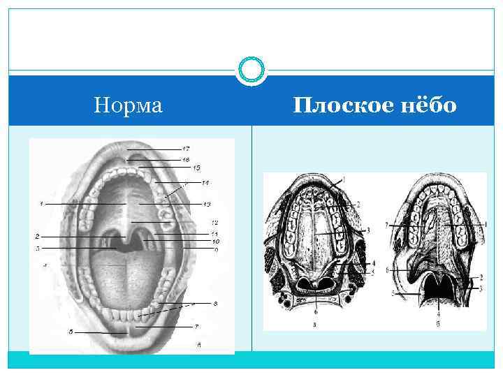 Норма  Плоское нёбо 