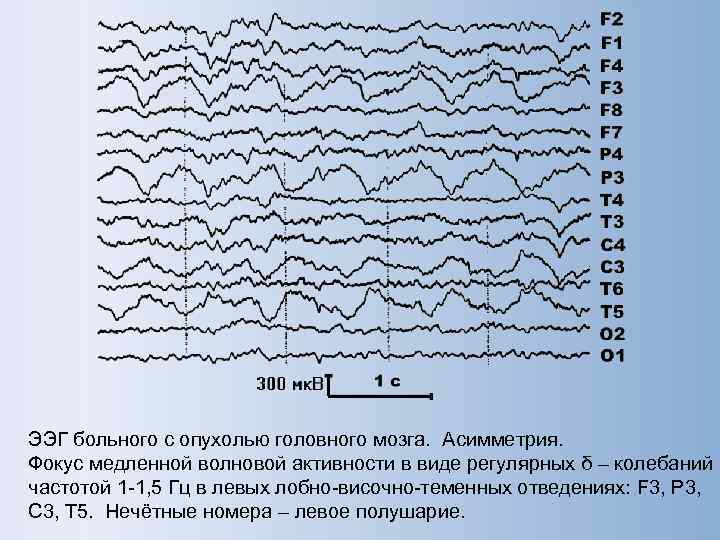 ЭЭГ больного с опухолью головного мозга. Асимметрия. Фокус медленной волновой активности в виде регулярных