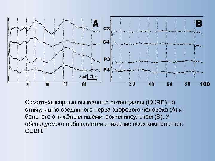 Соматосенсорные вызванные потенциалы (ССВП) на стимуляцию срединного нерва здорового человека (А) и больного с
