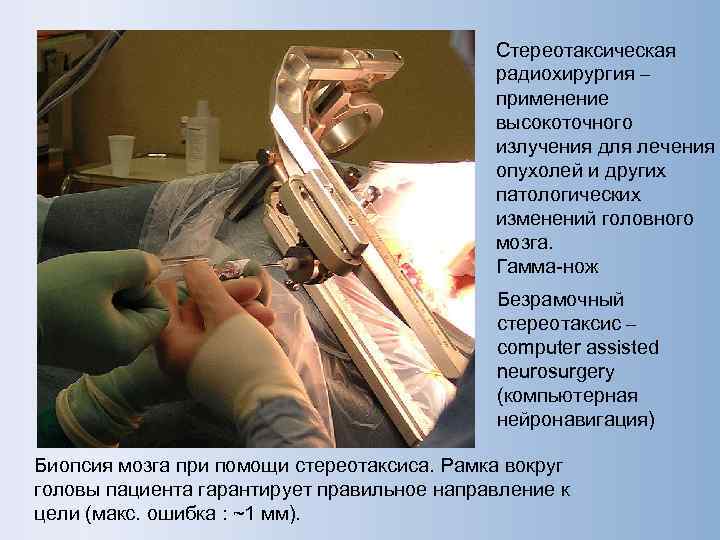     Стереотаксическая     радиохирургия ‒   