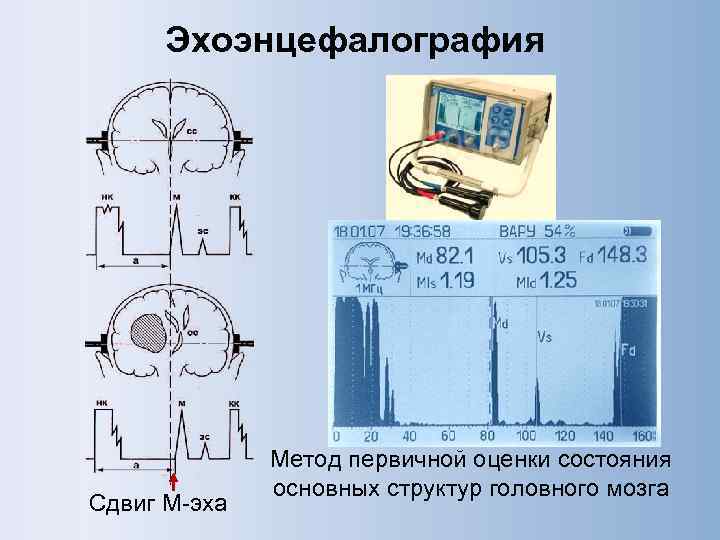  Эхоэнцефалография    Метод первичной оценки состояния    основных структур