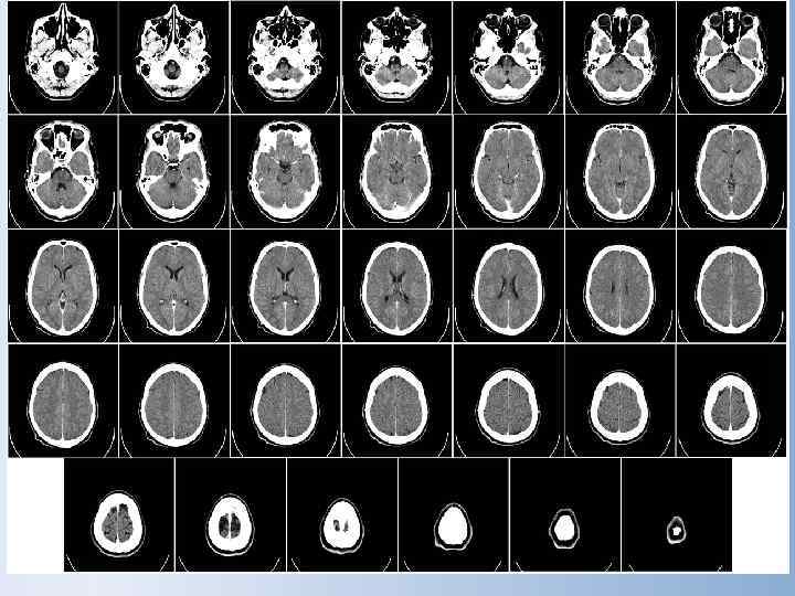   Рентгеновская компьютерная    томография. Источник рентгеновского излучения подвижен, узкий рентгеновский