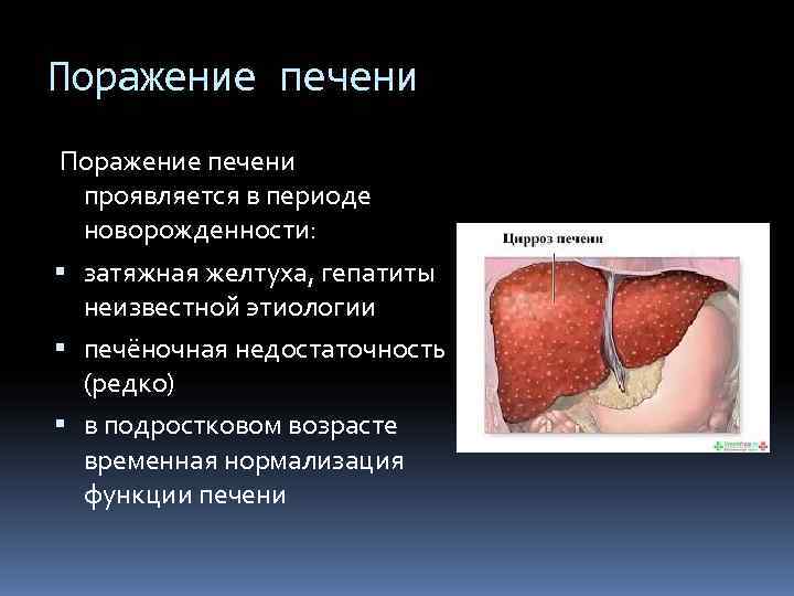 Поражение печени  проявляется в периоде  новорожденности:  затяжная желтуха, гепатиты  неизвестной