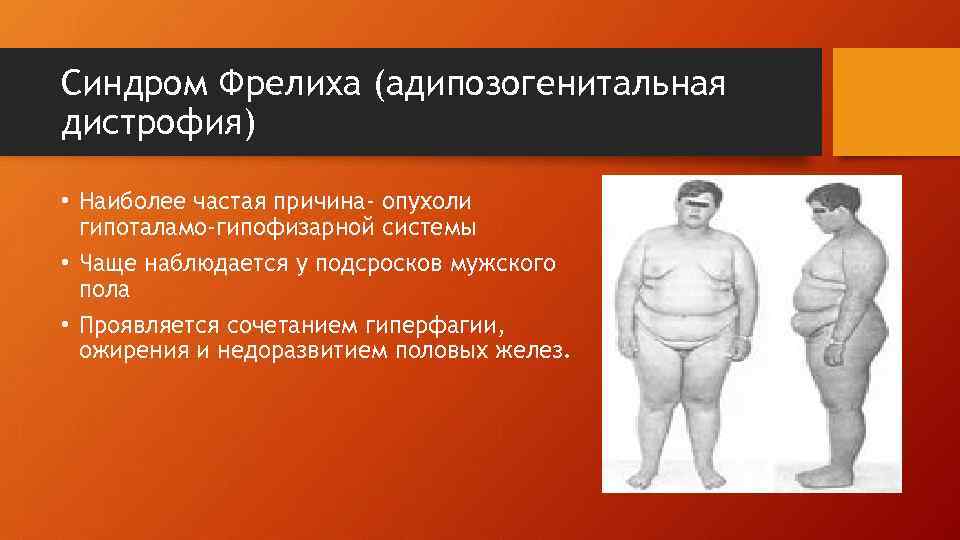 Синдром лоуренса муна бидля. Адипозо генитальный синдром. Пехкранца Бабинского Фрелиха. Адипозогенитальной дистрофии ожирение. Синдром Пехкранца Бабинского Фрелиха.