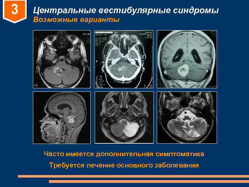3 Центральные вестибулярные синдромы Возможные варианты Часто имеется дополнительная симптоматика Требуется 3 Центральные вестибулярные синдромы Возможные варианты Часто имеется дополнительная симптоматика Требуется