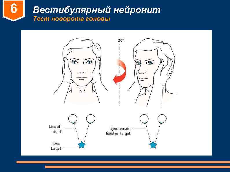 Вестибулярный нейронит. Вестибулярный нейронит симптомы. Вестибулярный неврит симптомы. Вестибулярная гимнастика при вестибулярном нейроните. Заболевание вестибулярного нерва.