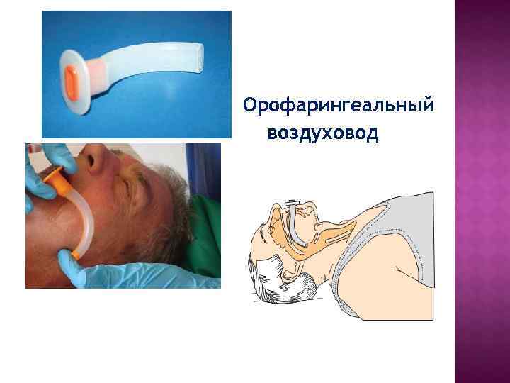 Орофарингеальный воздуховод Орофарингеальный воздуховод