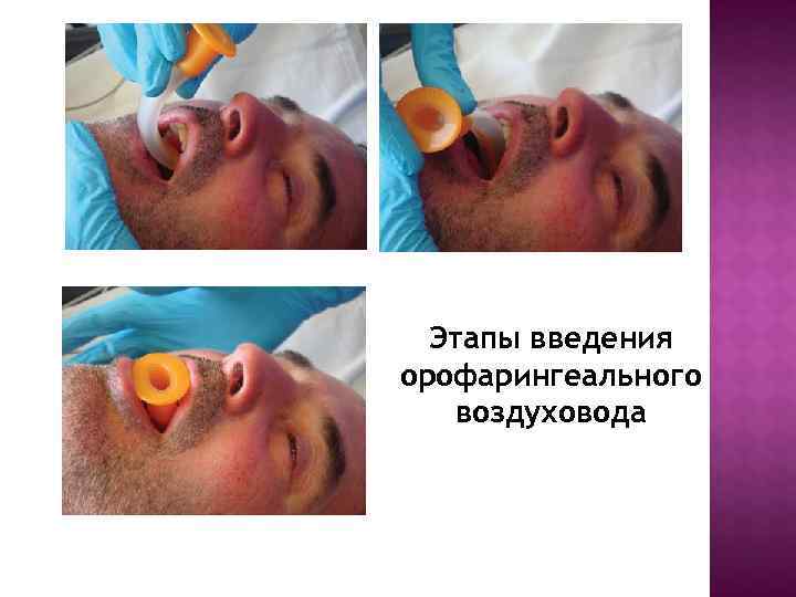 Этапы введения орофарингеального воздуховода Этапы введения орофарингеального воздуховода