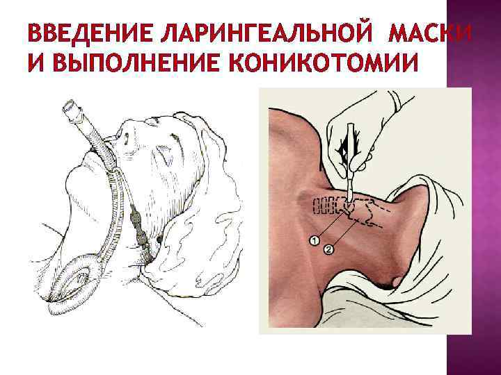 ВВЕДЕНИЕ ЛАРИНГЕАЛЬНОЙ МАСКИ И ВЫПОЛНЕНИЕ КОНИКОТОМИИ ВВЕДЕНИЕ ЛАРИНГЕАЛЬНОЙ МАСКИ И ВЫПОЛНЕНИЕ КОНИКОТОМИИ