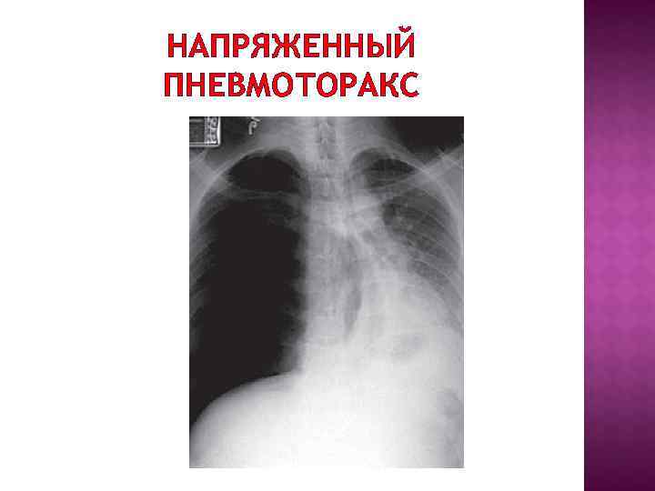 НАПРЯЖЕННЫЙ ПНЕВМОТОРАКС НАПРЯЖЕННЫЙ ПНЕВМОТОРАКС