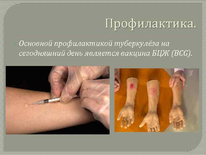      Профилактика.  Основной   профилактикой туберкулёза на сегодняшний