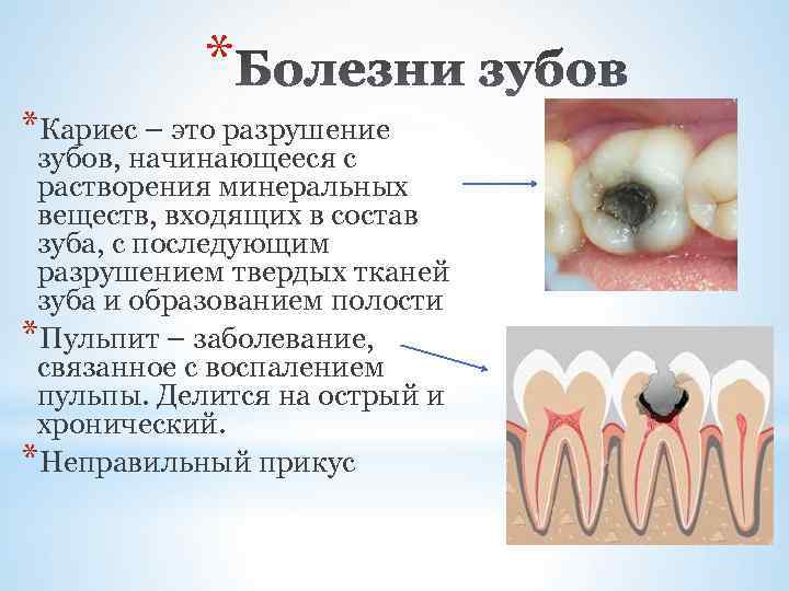   * *Кариес – это разрушение зубов, начинающееся с растворения минеральных веществ, входящих