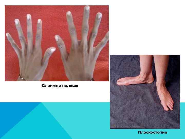 Длинные пальцы     Плоскостопие 