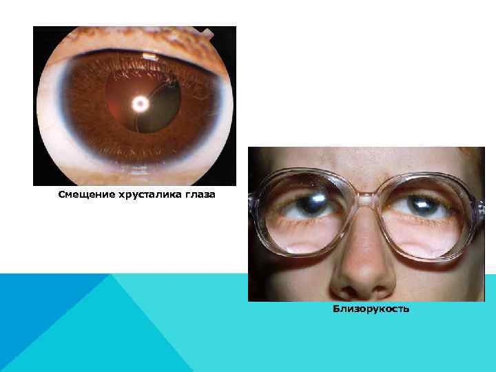 Смещение хрусталика глаза       Близорукость 