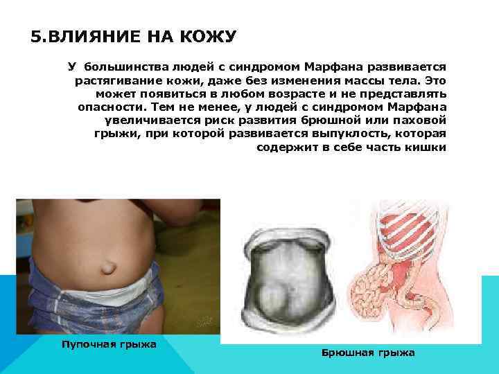 5. ВЛИЯНИЕ НА КОЖУ У большинства людей с синдромом Марфана развивается  растягивание кожи,