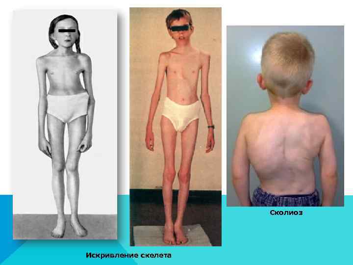      Сколиоз Искривление скелета 