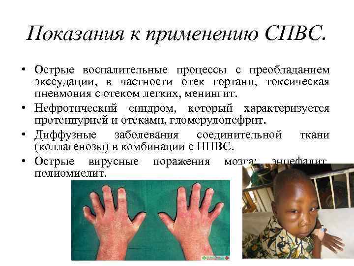 Показания к применению СПВС.  • Острые воспалительные процессы с преобладанием  экссудации, в